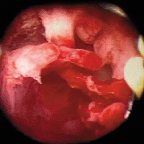 經期前滴滴答答? 小心是子宮內膜息肉